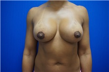 Breast Lift After Photo by Niki Christopoulos, MD, FACS; Chicago, IL - Case 35274