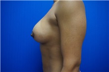 Breast Lift After Photo by Niki Christopoulos, MD, FACS; Chicago, IL - Case 35274