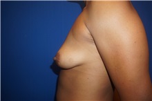Breast Lift Before Photo by Niki Christopoulos, MD, FACS; Chicago, IL - Case 35274