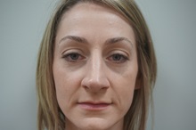 Eyelid Surgery After Photo by Niki Christopoulos, MD, FACS; Chicago, IL - Case 35276