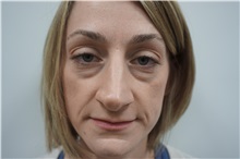 Eyelid Surgery Before Photo by Niki Christopoulos, MD, FACS; Chicago, IL - Case 35276