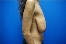 Breast Lift Before Photo by Niki Christopoulos, MD, FACS; Chicago, IL - Case 35277