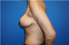 Breast Lift After Photo by Niki Christopoulos, MD, FACS; Chicago, IL - Case 35277