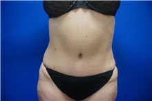 Tummy Tuck After Photo by Niki Christopoulos, MD, FACS; Chicago, IL - Case 35278
