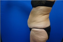 Tummy Tuck Before Photo by Niki Christopoulos, MD, FACS; Chicago, IL - Case 35278