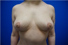 Breast Lift After Photo by Niki Christopoulos, MD, FACS; Chicago, IL - Case 35279