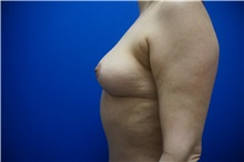 Breast Lift After Photo by Niki Christopoulos, MD, FACS; Chicago, IL - Case 35279