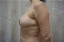 Breast Lift Before Photo by Niki Christopoulos, MD, FACS; Chicago, IL - Case 35279