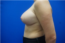 Breast Reduction After Photo by Niki Christopoulos, MD, FACS; Chicago, IL - Case 35280