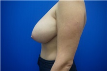 Breast Reduction Before Photo by Niki Christopoulos, MD, FACS; Chicago, IL - Case 35280