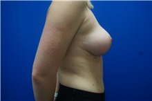 Breast Reduction After Photo by Niki Christopoulos, MD, FACS; Chicago, IL - Case 35281