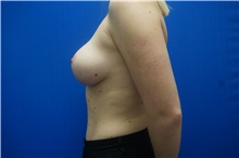 Breast Reduction After Photo by Niki Christopoulos, MD, FACS; Chicago, IL - Case 35281