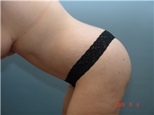 Body Lift After Photo by Gaurav Bharti, MD; ,  - Case 39611
