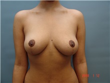 Breast Lift After Photo by Gaurav Bharti, MD; Huntersville, NC - Case 39612