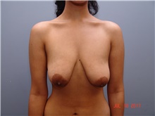Breast Lift Before Photo by Gaurav Bharti, MD; Huntersville, NC - Case 39612