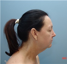 Facelift Before Photo by Gaurav Bharti, MD; Huntersville, NC - Case 39613