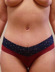 Tummy Tuck After Photo by Jonathan Amspacher, MD; St. Joseph, MO - Case 48225