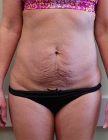 Tummy Tuck Before Photo by Jonathan Amspacher, MD; St. Joseph, MO - Case 48225