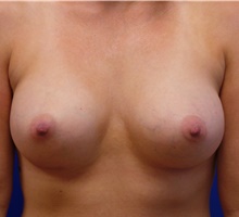 Breast Augmentation After Photo by Jonathan Amspacher, MD; St. Joseph, MO - Case 48226
