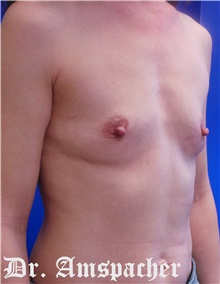 Breast Augmentation Before Photo by Jonathan Amspacher, MD; St. Joseph, MO - Case 48233