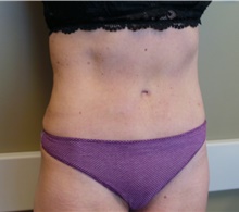 Tummy Tuck After Photo by Jonathan Amspacher, MD; St. Joseph, MO - Case 48234