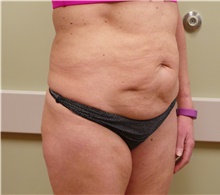 Tummy Tuck Before Photo by Jonathan Amspacher, MD; St. Joseph, MO - Case 48234