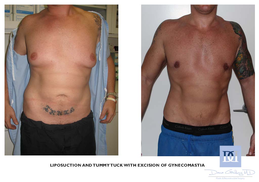 Male Breast Reduction Before and After Photos by Dana Goldberg, MD;  Jupiter, FL - Case 24685 | ASPS