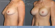 Breast Augmentation After Photo by Dana Goldberg, MD; Jupiter, FL - Case 28780