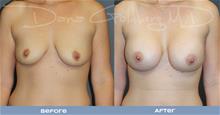 Breast Augmentation Before Photo by Dana Goldberg, MD; Jupiter, FL - Case 28780