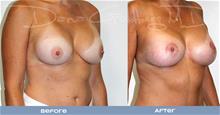 Breast Augmentation After Photo by Dana Goldberg, MD; Jupiter, FL - Case 28780