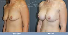 Breast Augmentation After Photo by Dana Goldberg, MD; Jupiter, FL - Case 28781