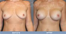 Breast Augmentation Before Photo by Dana Goldberg, MD; Jupiter, FL - Case 28782