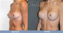 Breast Augmentation After Photo by Dana Goldberg, MD; Jupiter, FL - Case 28783