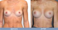 Breast Augmentation Before Photo by Dana Goldberg, MD; Jupiter, FL - Case 28783