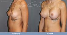 Breast Augmentation After Photo by Dana Goldberg, MD; Jupiter, FL - Case 28784