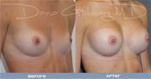 Breast Augmentation After Photo by Dana Goldberg, MD; Jupiter, FL - Case 28785