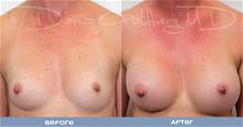 Breast Augmentation Before Photo by Dana Goldberg, MD; Jupiter, FL - Case 28785