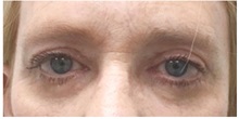 Eyelid Surgery After Photo by Darrick Antell, MD; New York, NY - Case 31837