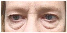 Eyelid Surgery Before Photo by Darrick Antell, MD; New York, NY - Case 31837