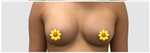 Breast Augmentation After Photo by Darrick Antell, MD; New York, NY - Case 31838