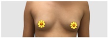 Breast Augmentation Before Photo by Darrick Antell, MD; New York, NY - Case 31838