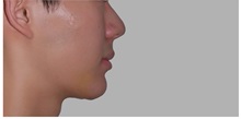 Chin Augmentation After Photo by Darrick Antell, MD; New York, NY - Case 31839