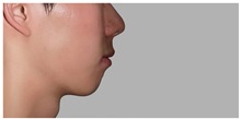 Chin Augmentation Before Photo by Darrick Antell, MD; New York, NY - Case 31839
