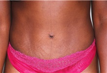 Tummy Tuck After Photo by Darrick Antell, MD; New York, NY - Case 33541