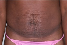 Tummy Tuck Before Photo by Darrick Antell, MD; New York, NY - Case 33541