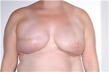 Breast Reconstruction After Photo by Darrick Antell, MD; New York, NY - Case 35042