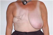 Breast Reconstruction Before Photo by Darrick Antell, MD; New York, NY - Case 35042