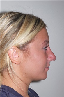 Rhinoplasty After Photo by Darrick Antell, MD; New York, NY - Case 35043