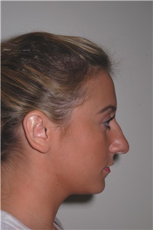 Rhinoplasty Before Photo by Darrick Antell, MD; New York, NY - Case 35043