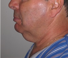 Facelift Before Photo by Darrick Antell, MD; New York, NY - Case 35044